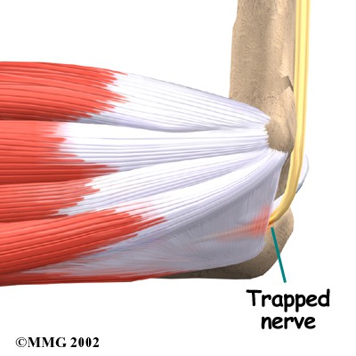 CUBITAL TUNNEL SYNDROME